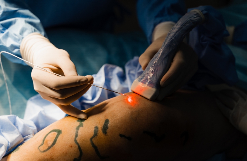 Laser vein treatment